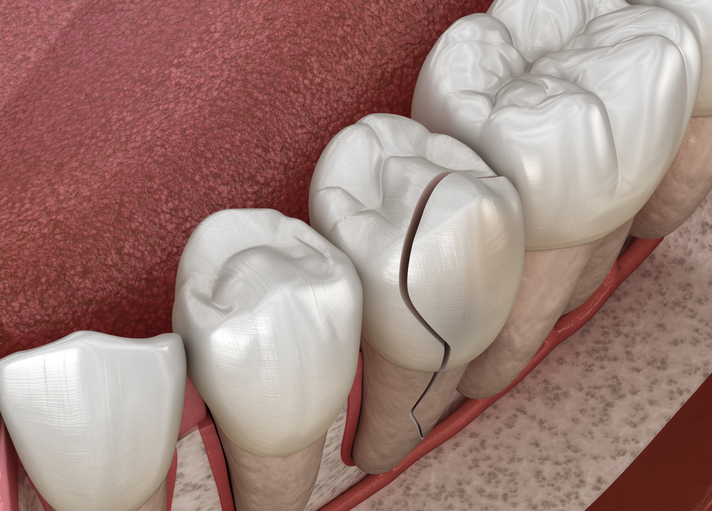 Chipped tooth illustration showing a damaged molar, highlighting dental anatomy in context of emergency dental care for chipped teeth in Huntington Beach, CA.