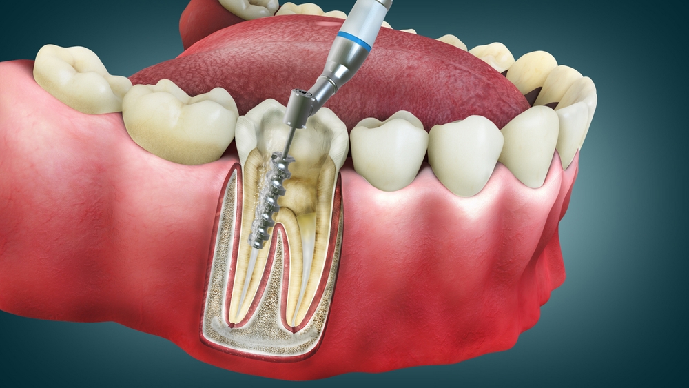 Illustration of a root canal procedure, showing dental tools and the interior of a tooth, relevant to root canal treatment offered by Noleen Dental in Huntington Beach, CA.