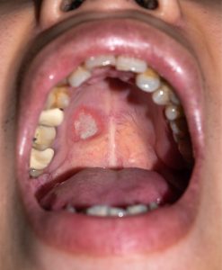 ulcer in mouth