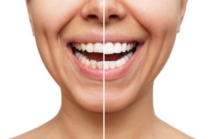before and after veneers
