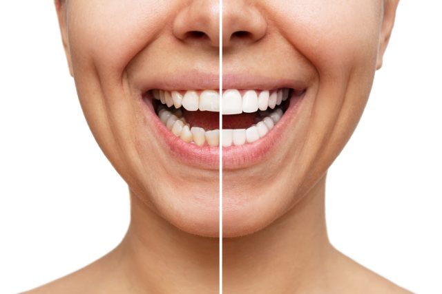 before and after veneers