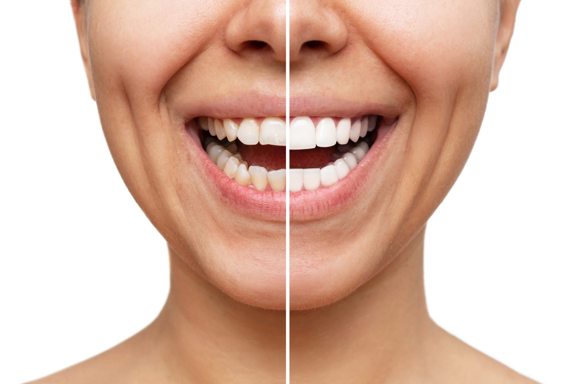 Smiling woman with porcelain veneers on one side and natural teeth on the other, illustrating the aesthetic benefits of dental veneers at Noleen Dental in Huntington Beach, CA.