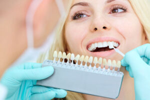 color matching veneers
