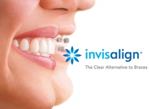 Close-up of a smiling person showcasing Invisalign clear aligners alongside traditional braces, with the Invisalign logo and tagline "The Clear Alternative to Braces," emphasizing orthodontic solutions for achieving a better smile.