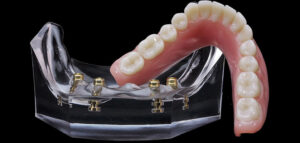 overdentures