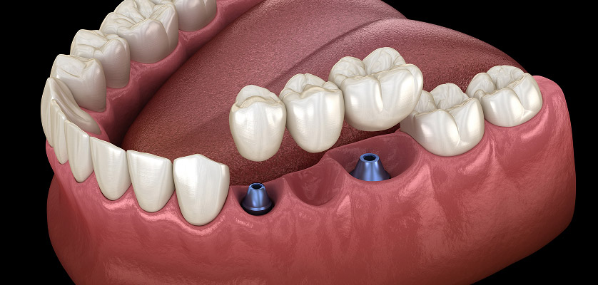 3D illustration of dental implants in the jawbone, showcasing titanium posts and surrounding teeth, relevant to single-tooth dental implant treatments.