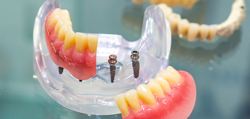 Implant-supported dentures model with dental implants, showcasing artificial teeth and abutments, illustrating advanced dental restoration techniques.