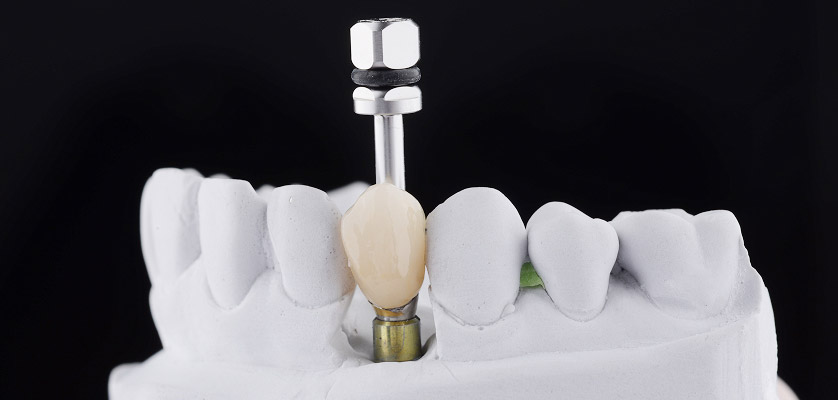 Dental implant model showcasing a titanium post and ceramic crown, illustrating single-tooth replacement procedure relevant to Noleen Dental's implant services.