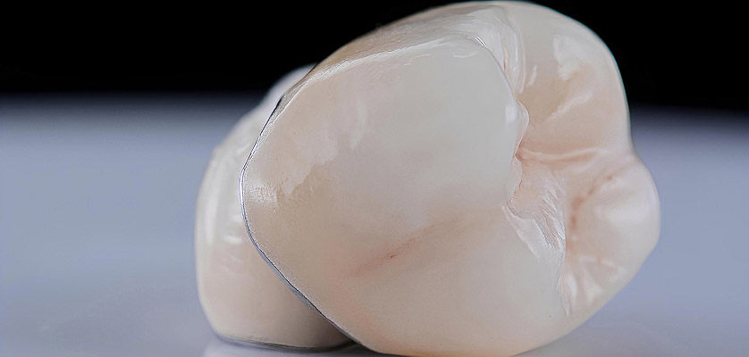 Dental crown representing artificial tooth restoration for dental implants, showcasing realistic texture and color, emphasizing natural look and functionality.