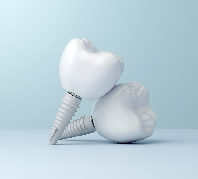 Dental implants with ceramic crowns on screws, representing tooth replacement solutions offered by Noleen Dental in Huntington Beach, CA.