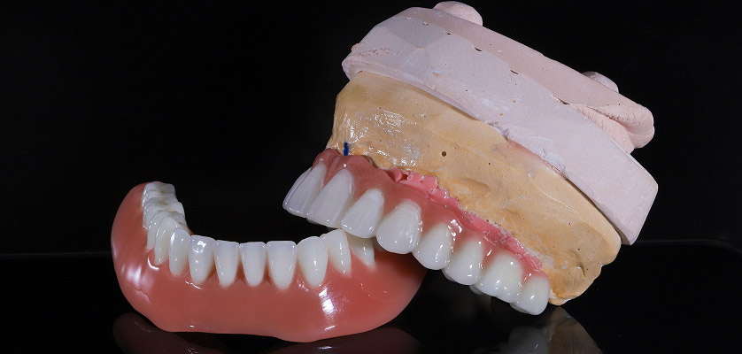 Dental model showcasing prosthetic teeth and gums, illustrating implant-supported dentures and full-arch replacement options related to dental implants.
