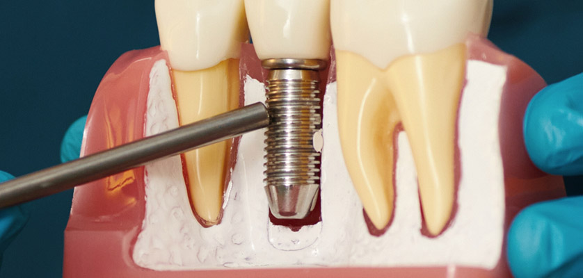 Dental implant model with titanium implant body being inserted into jawbone, illustrating dental implant procedure and components related to tooth replacement options.