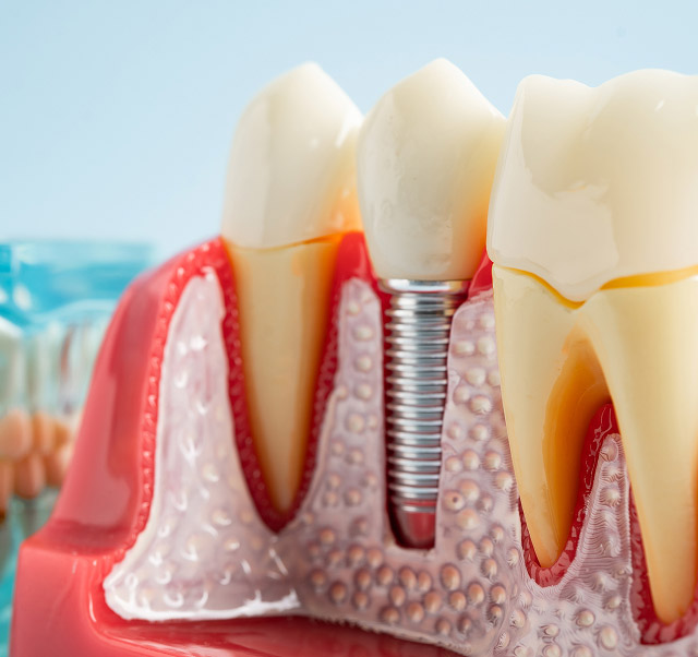 Dental implant model showing titanium post with two crowns, illustrating single-tooth replacement in dental care.